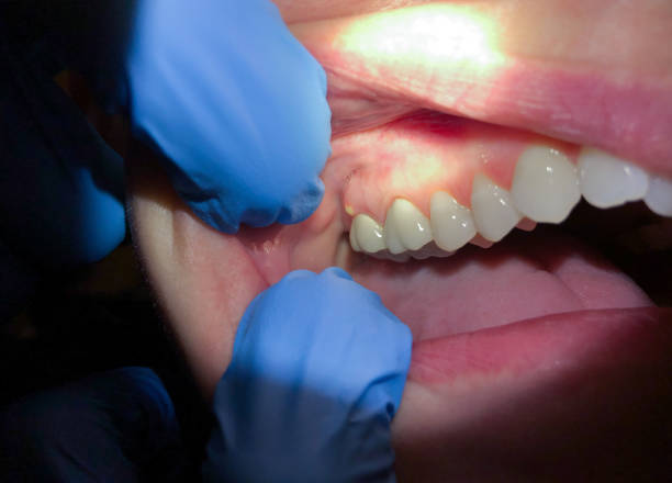 Best Emergency Treatment for Oral Infections in Pasco, WA