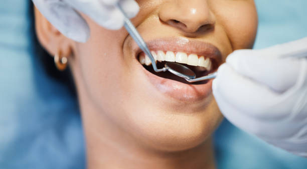 Best Emergency Wisdom Tooth Extraction in Pasco, WA